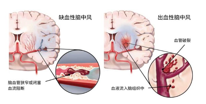 得了脑中风保险公司怎么赔